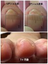 第3趾巻き爪UPジェル