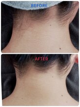 サロンドムーン(salon do Moon)/うなじ脱毛