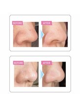 リノア(Linoa)/毛穴の黒ずみ、角栓、詰まりに◎