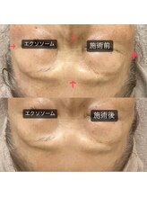 グラン ジュテ/エクソソーム注入