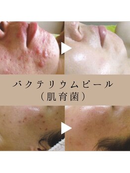デン(DEN)/バクテリウムピール