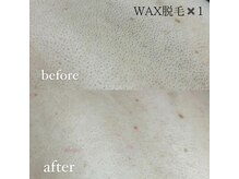 ユウユウ(YUYU)/背中　WAX脱毛