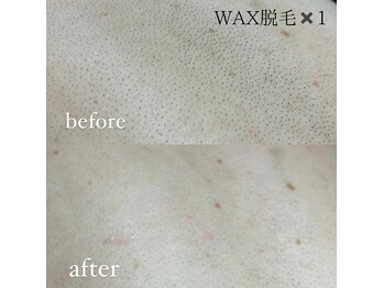 ユウユウ(YUYU)/背中 WAX脱毛