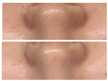 ベル(Bell)/毛穴洗浄フェイシャル/毛穴