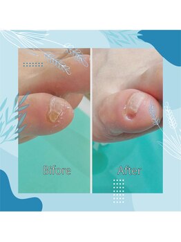 巻き爪補正店 秋葉原店/ 【副爪ケア】