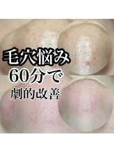 アネラ(ANELA)/毛穴エクストラクション症例.3