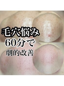 アネラ(ANELA)/毛穴エクストラクション症例.3