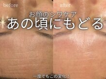 サロンドグレース(Salon de Grace)の雰囲気（無針水光注入/たるみケア．シワシミ予防，トーンアップ）