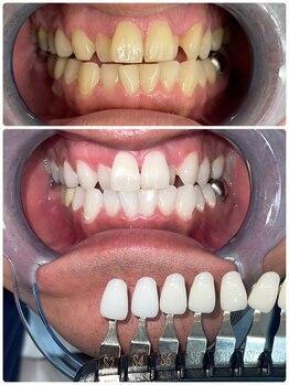 エクシアホワイトニング 札幌中島公園店/Before After［ホワイトニング］