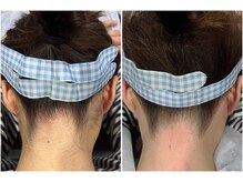 サロン ラズリ(SALON Lazuli)/【うなじ脱毛】高さ合わせも◎