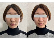 ワイ(Y)/シミシワたるみ速攻小顔効果も！