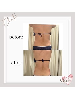 クイーン(QUEEN)/脂肪冷却