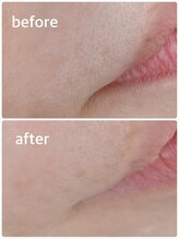 メイクマジック(Makemagic)/お口周りのうぶ毛