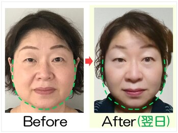 小顔矯正エステ プリュムレーヴ/50代｜頬たるみリフト