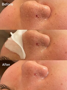 ラナ(Lana)/3D毛穴洗浄