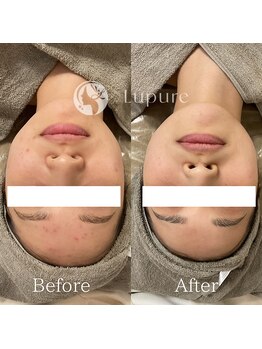 ルプレ(Lupure)/ハーブピーリング9回目