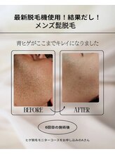 ロビナ 長野駅前店(Lovina)/ビフォーアフター(ヒゲ脱毛)