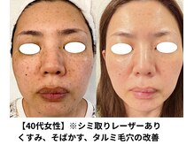 ボニータ(Bonita)/【Lit】ヒト羊膜幹細胞エステ2倍