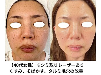 ボニータ(Bonita)/【Lit】ヒト羊膜幹細胞エステ2倍