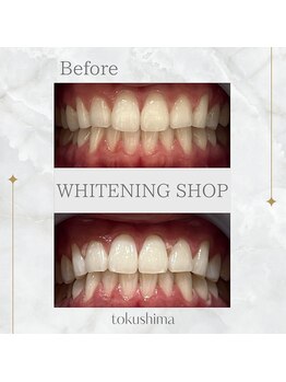 ホワイトニングショップ 徳島店/セルフホワイトニング1回の効果