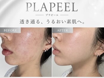 ビジュー(BIJOU)の写真/美肌にも小顔にもなりたい方、必見！当店の本格ケアで両方を叶えます♪丁寧なカウンセリングにも定評あり◎