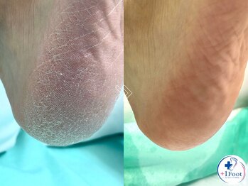 プラスワンフット 本厚木(+1 Foot)/ガサガサかかとを、つるつるに♪
