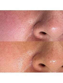 エン(enn)/【毛穴】