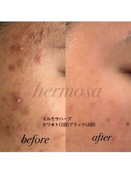 ルミリア(Lumiria)/長年のニキビにアプローチ