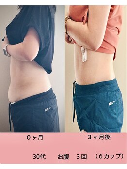 まつもと美容整体 整骨院/脂肪冷却効果!