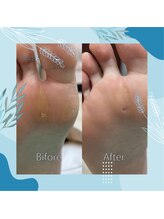 巻き爪補正店 秋葉原店/【硬いタコ/魚の目ケア】