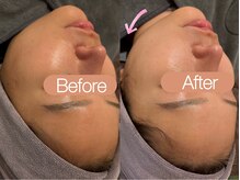 クレヴィア バイ サイバーエステ(CREBIA)/ハーブピーリング＋小顔ショット