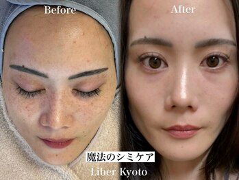 リベルキョウト 京都駅前店(Liber Kyoto)/魔法のシミケア