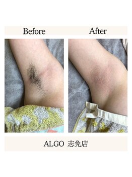 アルゴ 志免店(ALGO)/WAX脱毛人気第二位はうなじ!!