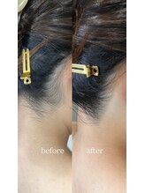 テラスアヴェダビューティー 岡山(Terrace Aveda beauty)/脱毛前のうなじづくり