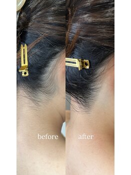 テラスアヴェダビューティー 岡山(Terrace Aveda beauty)/脱毛前のうなじづくり