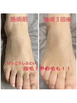 モモハダ(momo hada)/足の指毛もキレイに