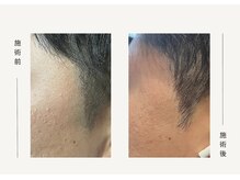 クレビア(CREVIA)/Men'sもみあげ脱毛◆BeforeAfter