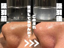 眉ダンディズム 大阪天神橋六丁目店/ハイドラで取れたお肌の汚れ