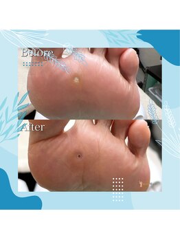 巻き爪補正店 秋葉原店/【硬いタコ/魚の目ケア】