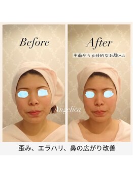 アンジェリカ(Angelica)/エラ張り、歪み、鼻の広がり改善