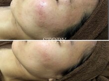 ストーリー 沼津店(STORY)/ハーブピーリング専門店STORY