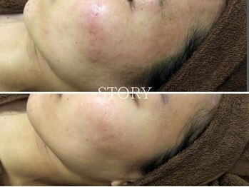 ストーリー 沼津店(STORY)/ハーブピーリング専門店STORY