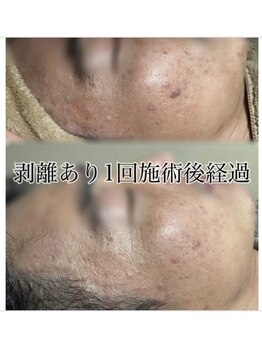 エミルカ 自由が丘店(EMILUCA)/ハード ハーブフェイシャル