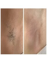 アットユウ(@yu)/シュガーリング《脇》