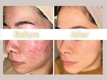 ハル(HARU.)の雰囲気（皮膚科や高い化粧品でも改善しなかったブツブツもお任せ下さい！）