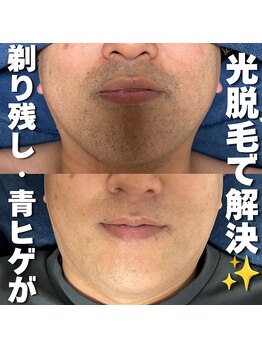 カナウ(KANAU)の写真/【メンズVIO脱毛が5,500円】全身脱毛やヒゲ脱毛が人気♪30代40代の男性が多くリピートして卒業しています！
