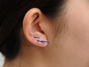 やけの鍼灸整骨院/耳鍼