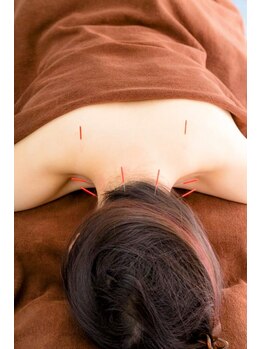 美麗鍼灸院/首・肩の鍼（電気パルス付き）