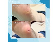 巻き爪補正店 秋葉原店/【硬いタコ/魚の目ケア】