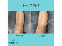 アクト クロ(ACT curro)/【キッズ】脱毛施術例